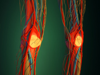 立体膝盖骨病变C4D模型